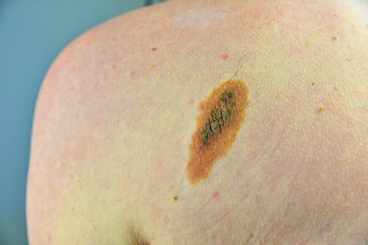 Skin Cancer symptoms 2