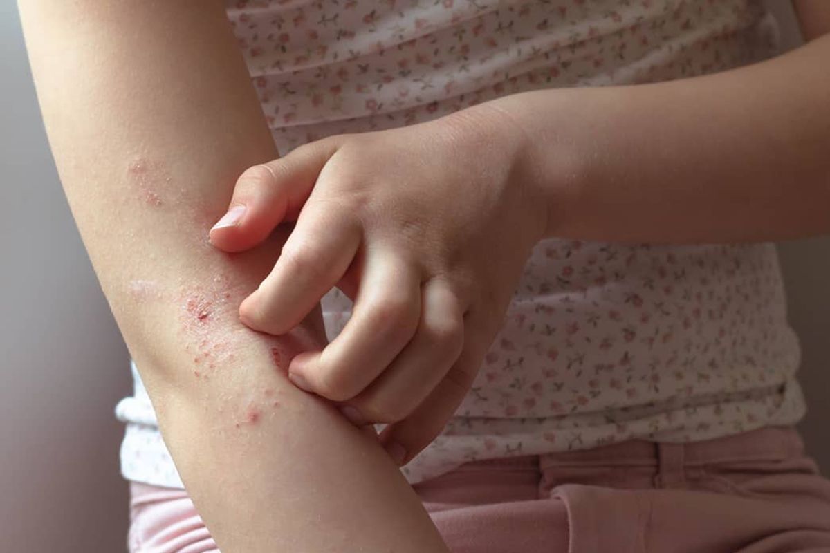 Eczema & Dermatitis