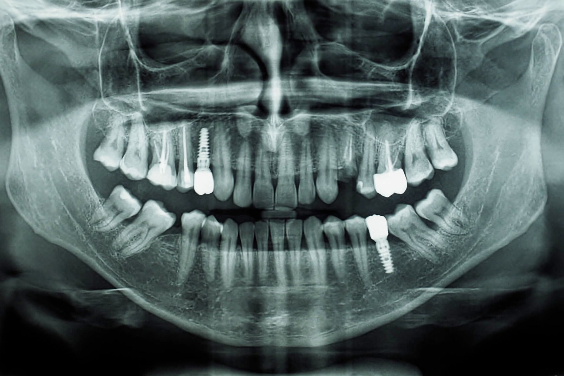 Panoramica dentale