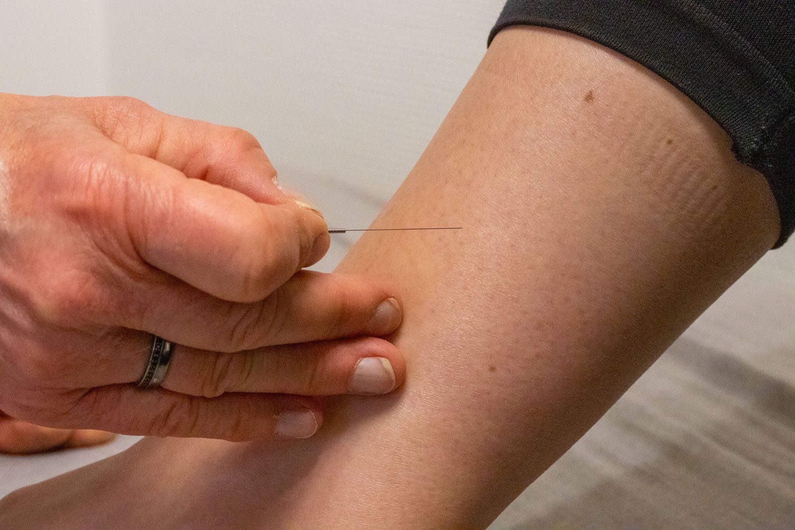 Akupunktur og hypnose til lindring af gener under graviditeten