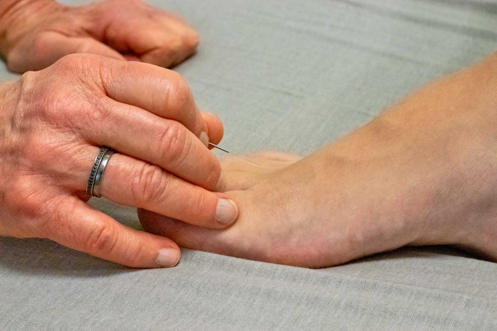 Fødselsmodnende akupunkturbehandling