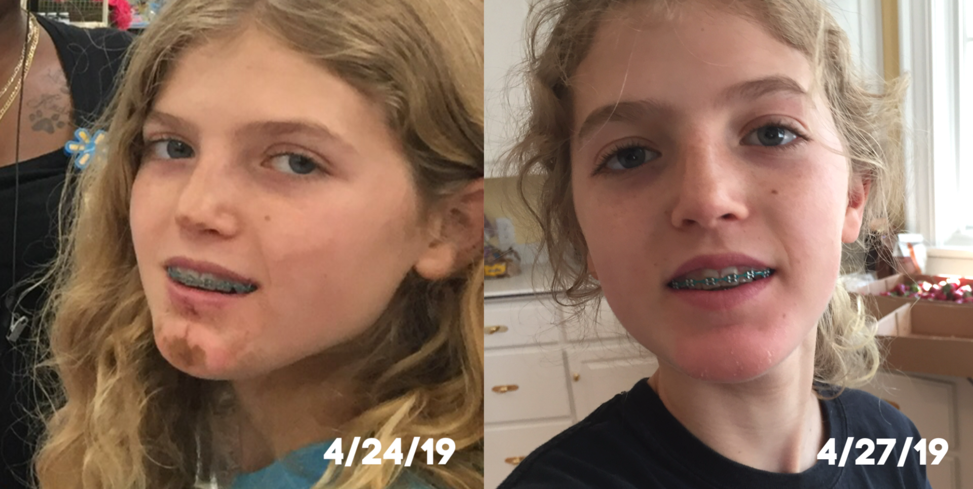 Side-by-side photos of a person with sun. The left photo is dated 4/24/19, and the right is 4/27/19.
