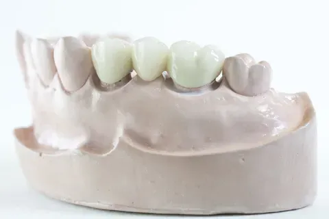 Dental Bridge Dental Bridge