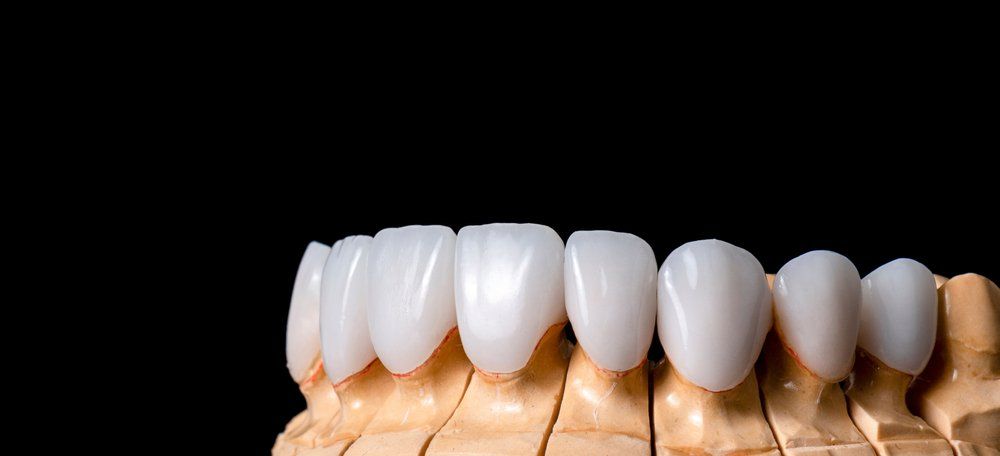 Veneers Sample In Dentures Veneers Sample In Dentures