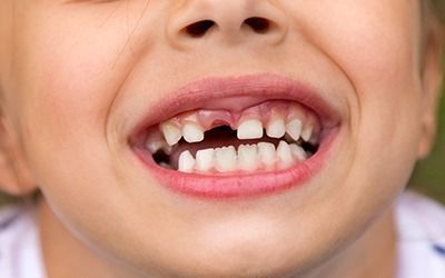 Close-up of a child smiling, showing missing and crooked front teeth