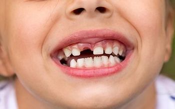 Close-up of a smiling child showing missing front teeth and braces-like white teeth