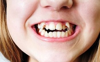 Close-up of a child’s mouth with crooked teeth and a smiling expression