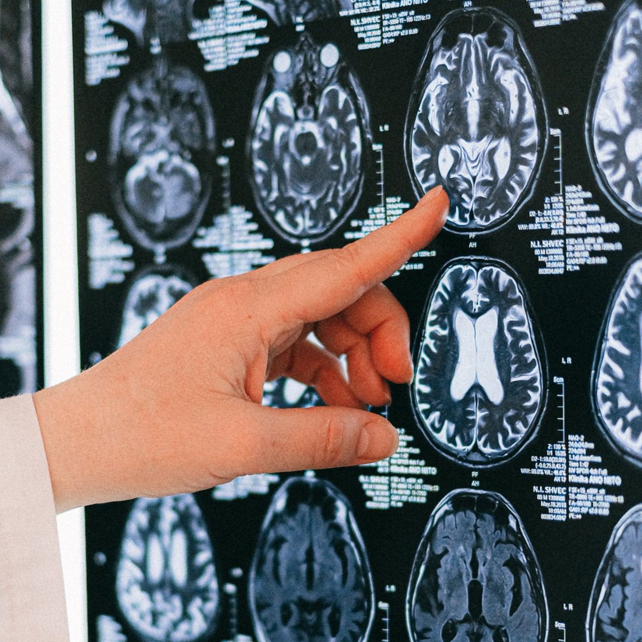 Vinger wijst naar scan van een brein
