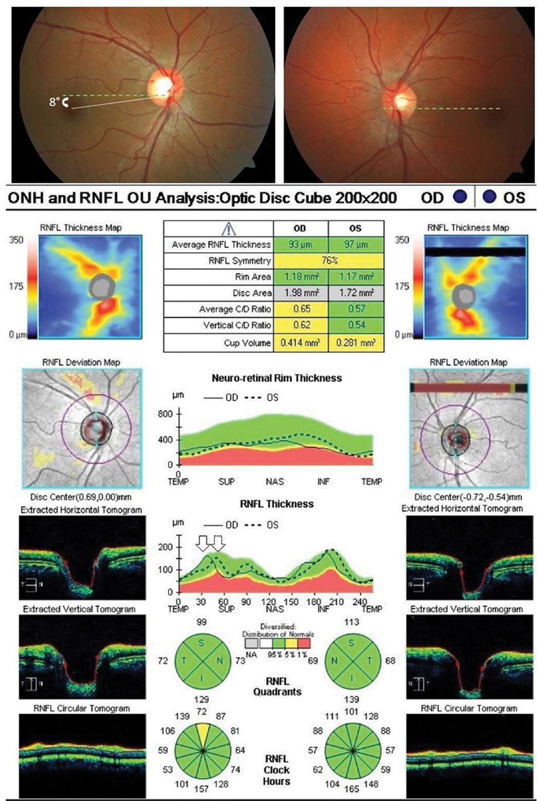 Retinal scan analysis: Left and right eye views, optic nerve health assessment, and OCT scans, assessing the optic nerve fiber layer.