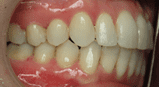 Close-up of a person's teeth showing slight crowding and healthy gums.