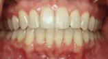 Close-up of human teeth, showing both upper and lower sets in good condition with a small dark spot.