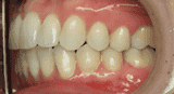 Close-up of teeth, displaying a set of upper and lower teeth with their gums.