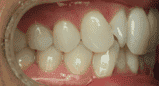 Close-up of a person's teeth, showing alignment and color.