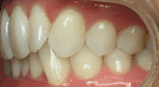 Close-up of a person's teeth, showing slight crowding and healthy pink gums.