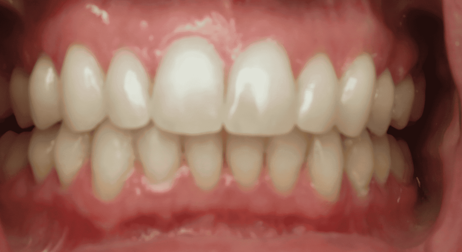 Close-up of a person's teeth. They are white, evenly spaced, and in good condition. The gums are pink.