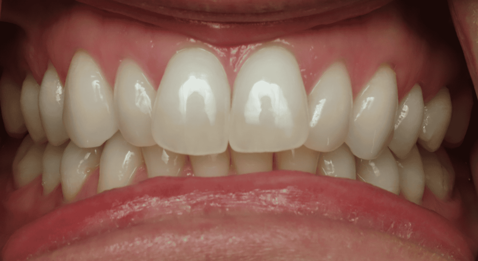 Close-up view of a person's teeth, showing a full set of bright white teeth and pink gums.