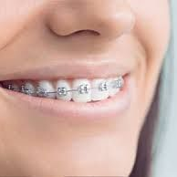 Close-up of a person's mouth with metal braces on the teeth; smiling.
