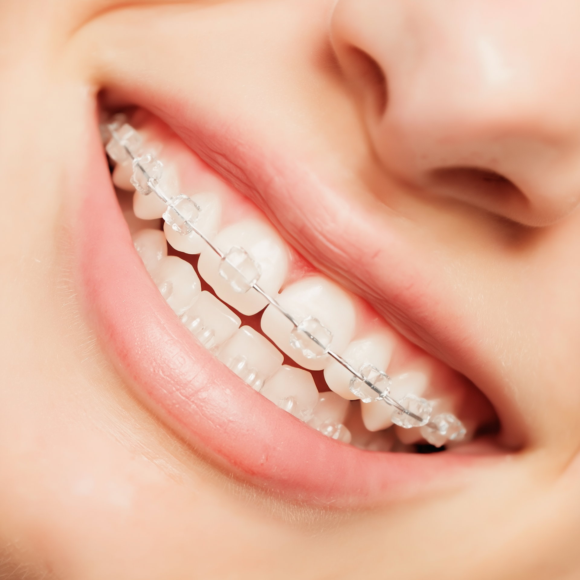 Close-up of a smiling mouth with clear braces on the upper and lower teeth, showing a healthy smile.