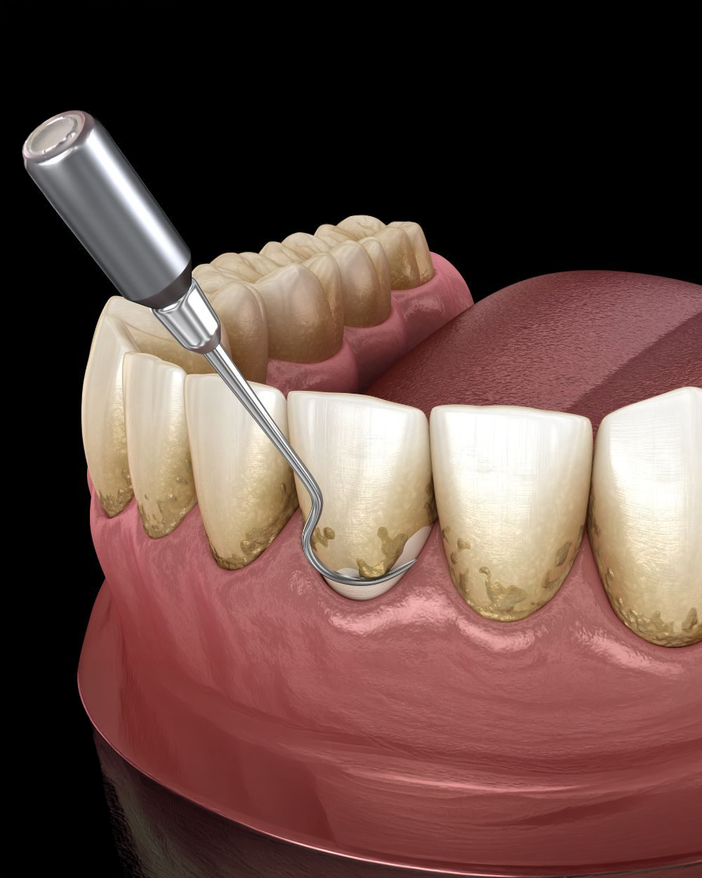 Deep Cleaning (Scaling and Root Planing)