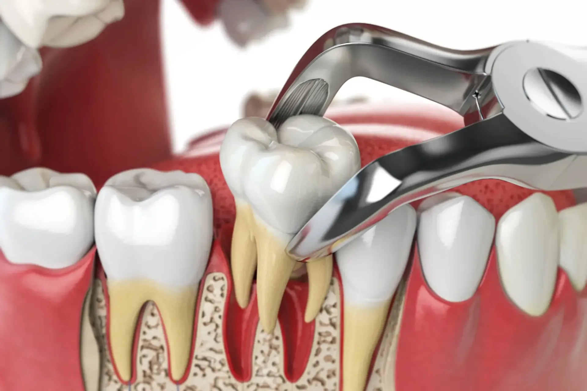 Extractions