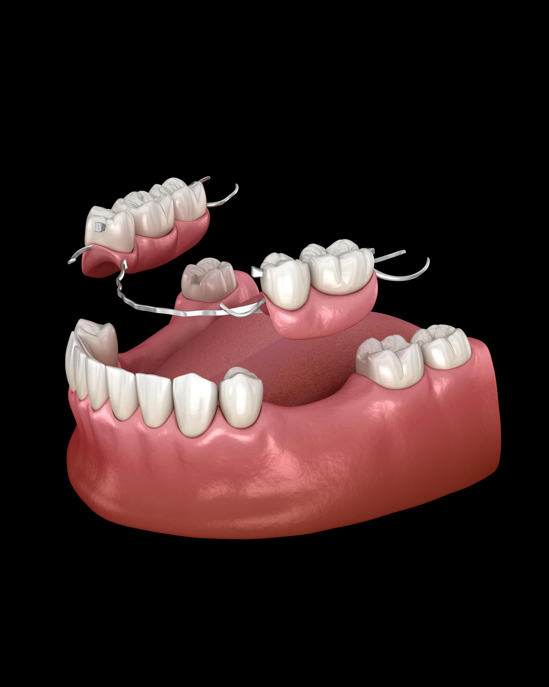 Partial Dentures