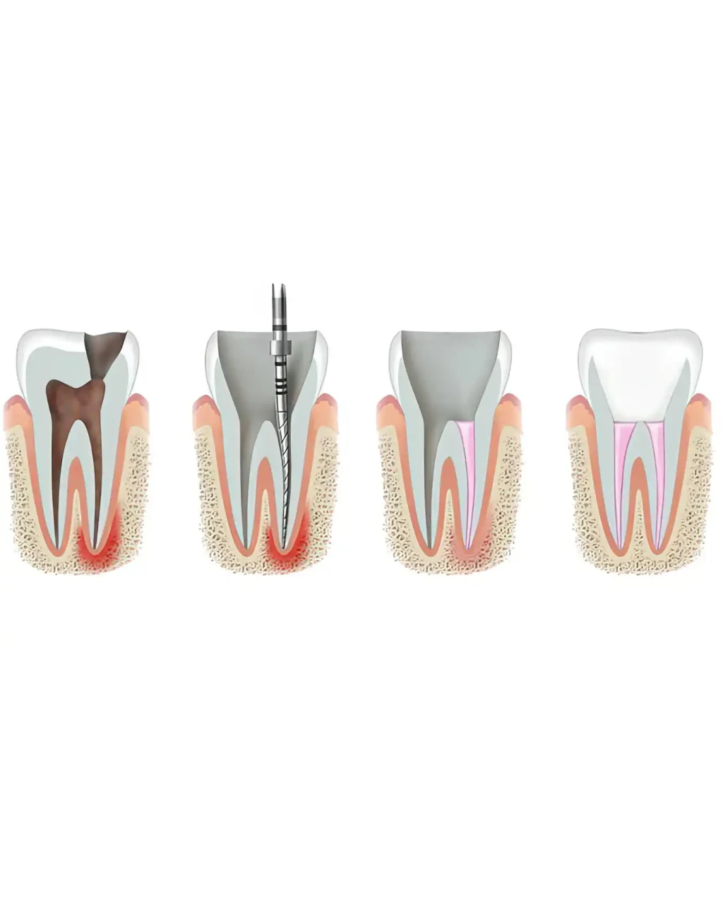 Root Canal Treatment