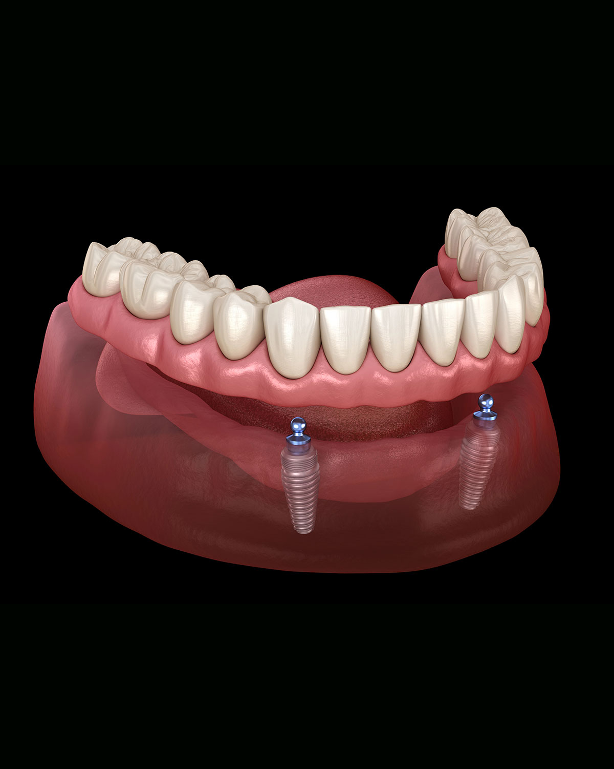 Over Denture (2 implants or more)