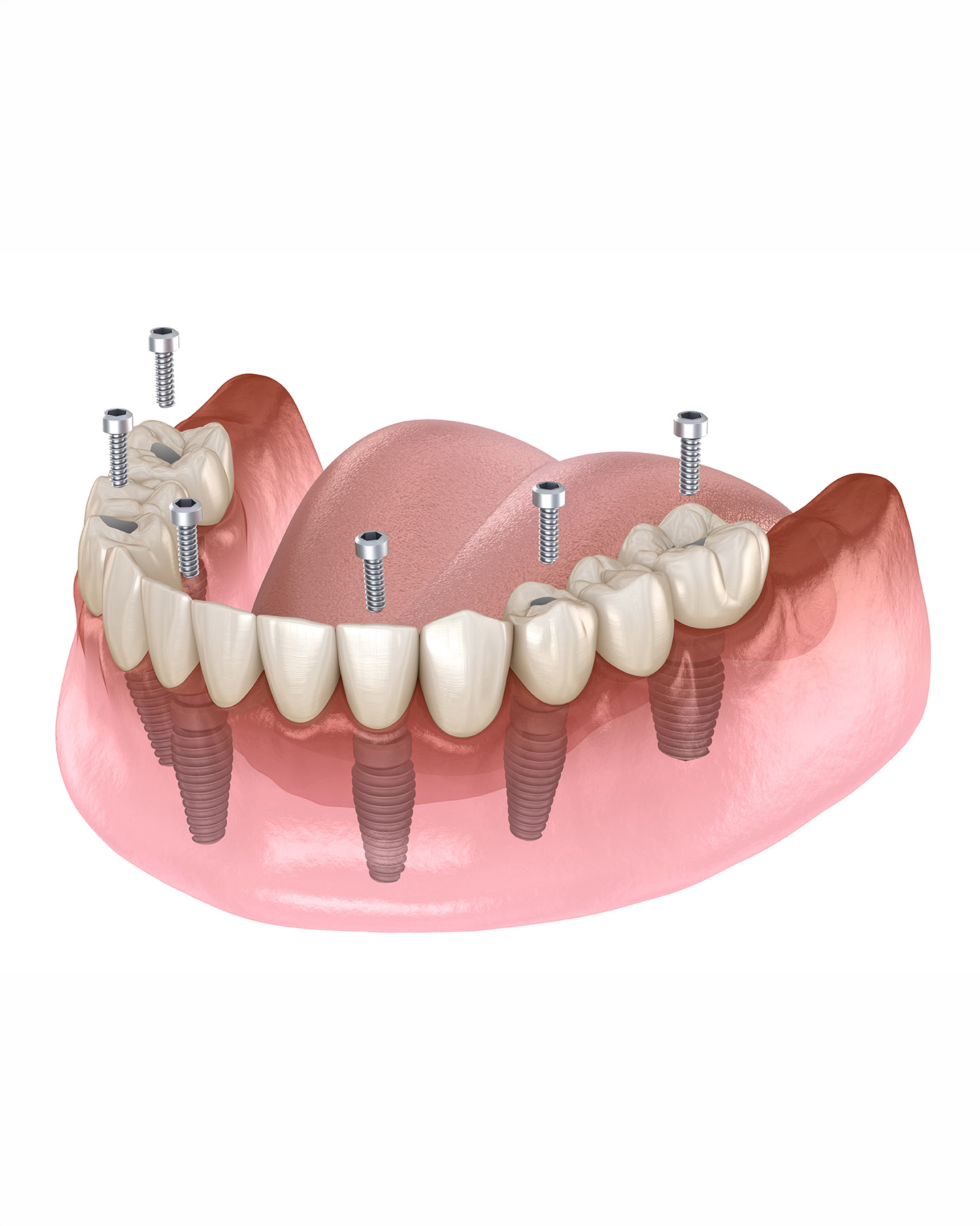 Implant Retained Denture (4 implants or more)