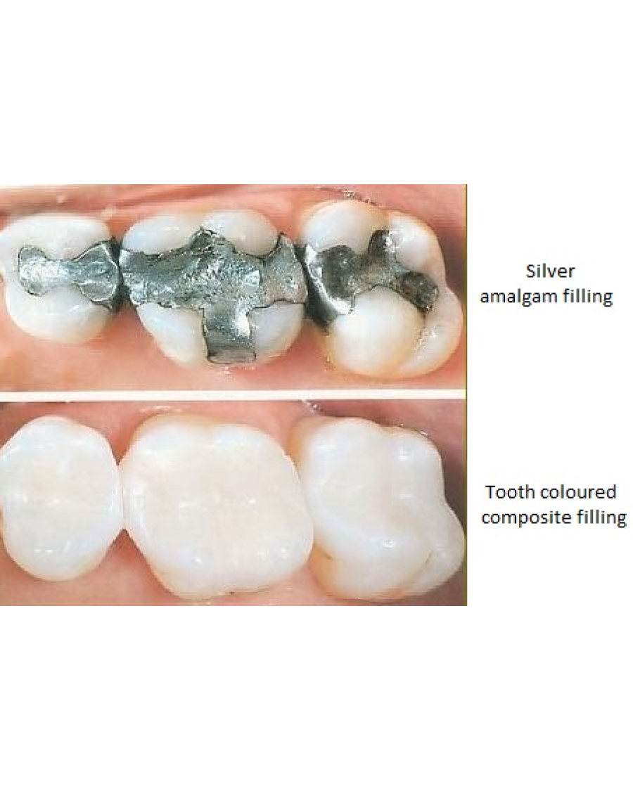 Fillings
