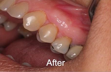 Patient after a gum graft procedure