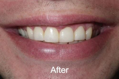 After Dental Veneers at Aurora Dental Care