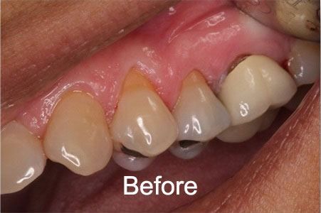 Patient before a gum graft procedure