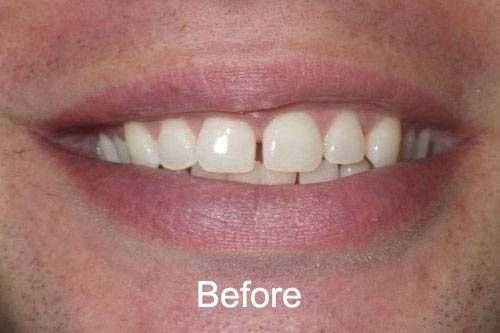 Before Veneers at our Seattle, WA dental practice