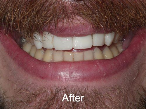 Patient After Veneers in Seattle, WA