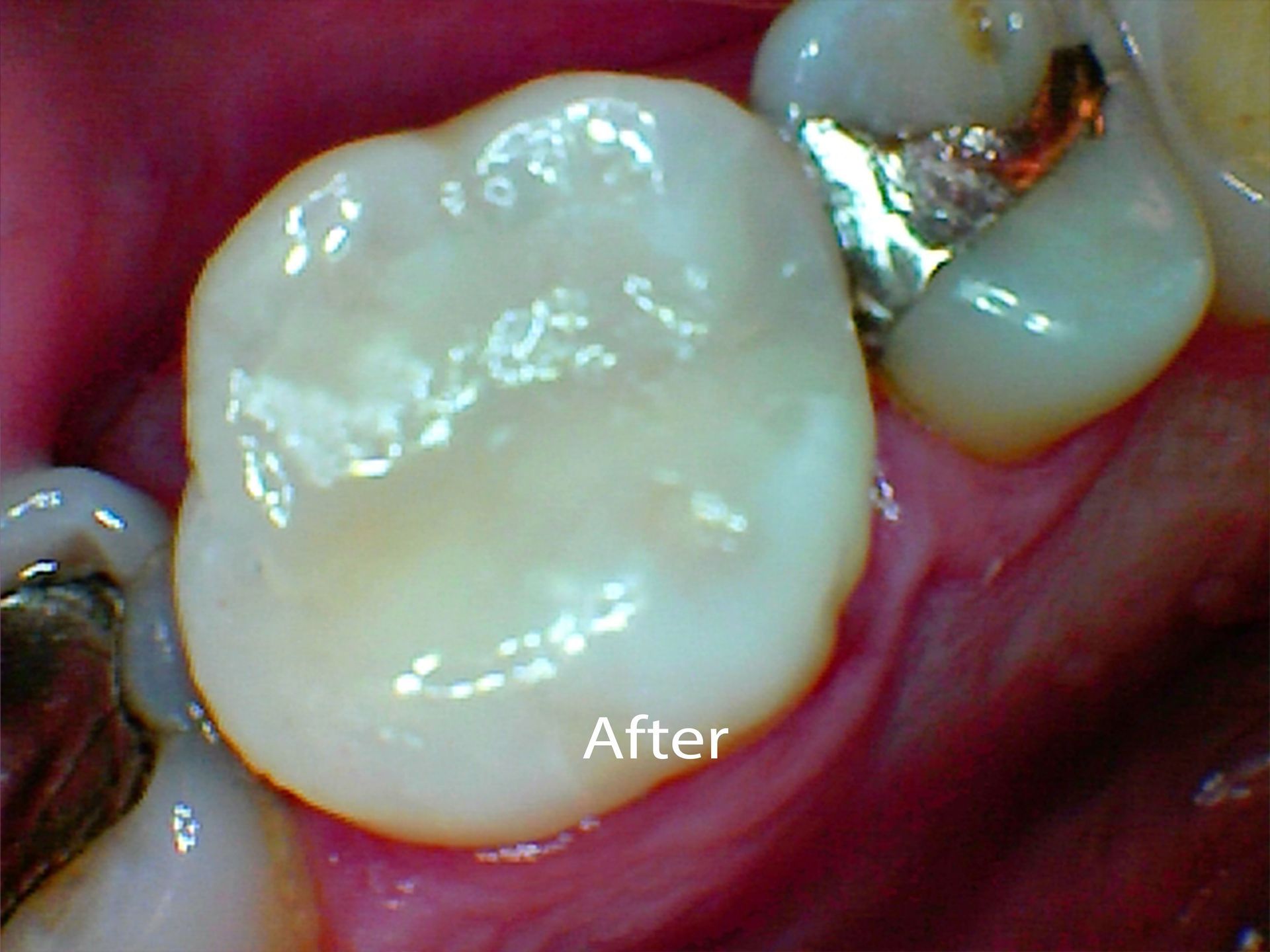 After Composite fillings in Seattle