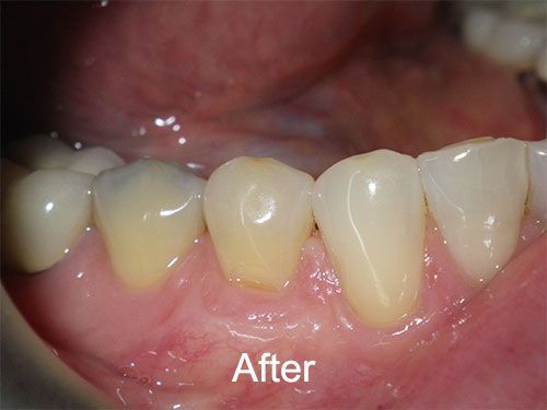 AFter Gum Grafting