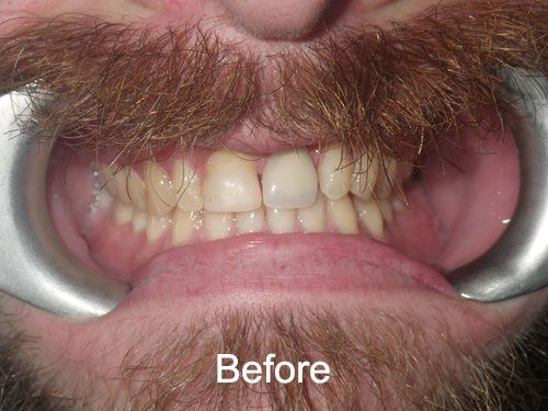 Patient Before veneers in Seattle