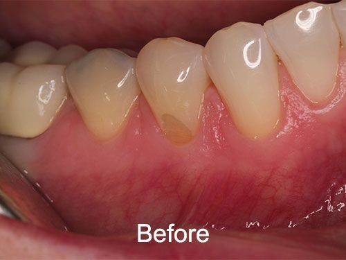 Gum Grafting before
