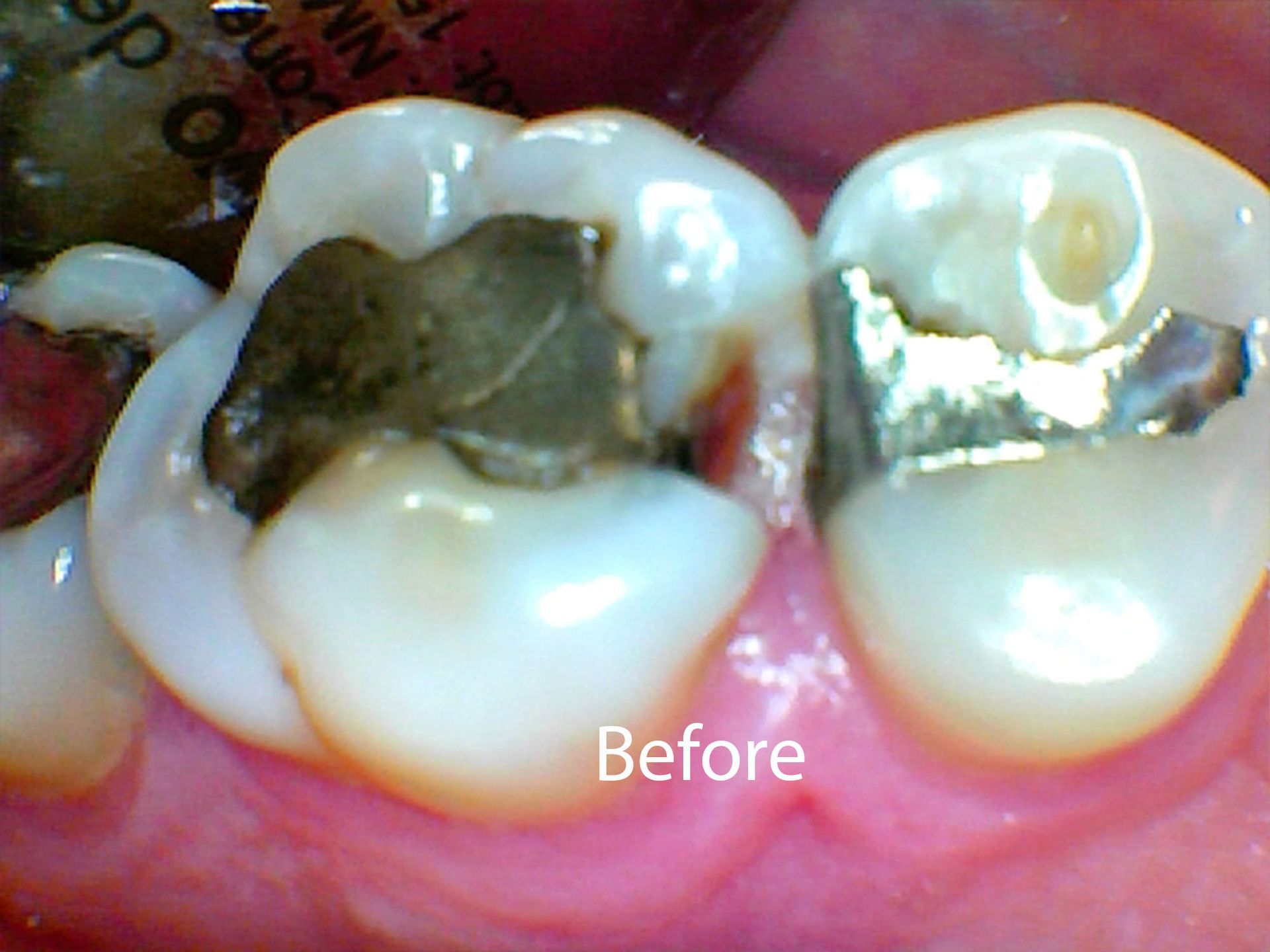 Before composite fillings in Seattle, WA