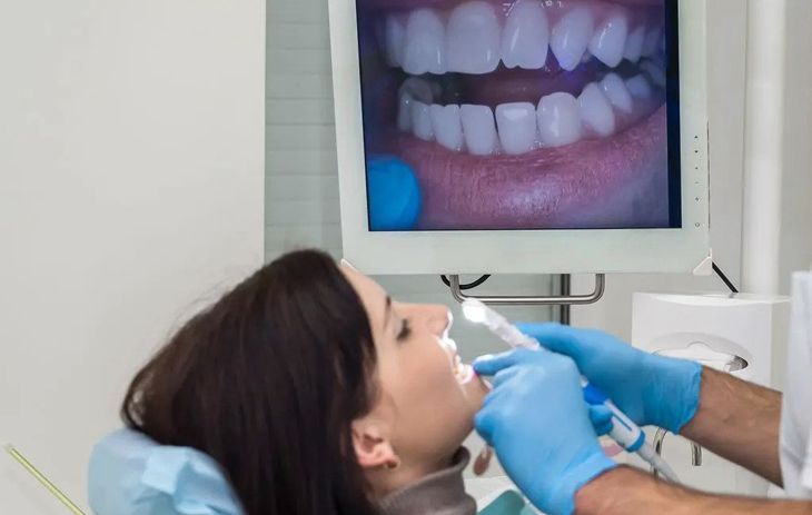 Teeth whitening before and after