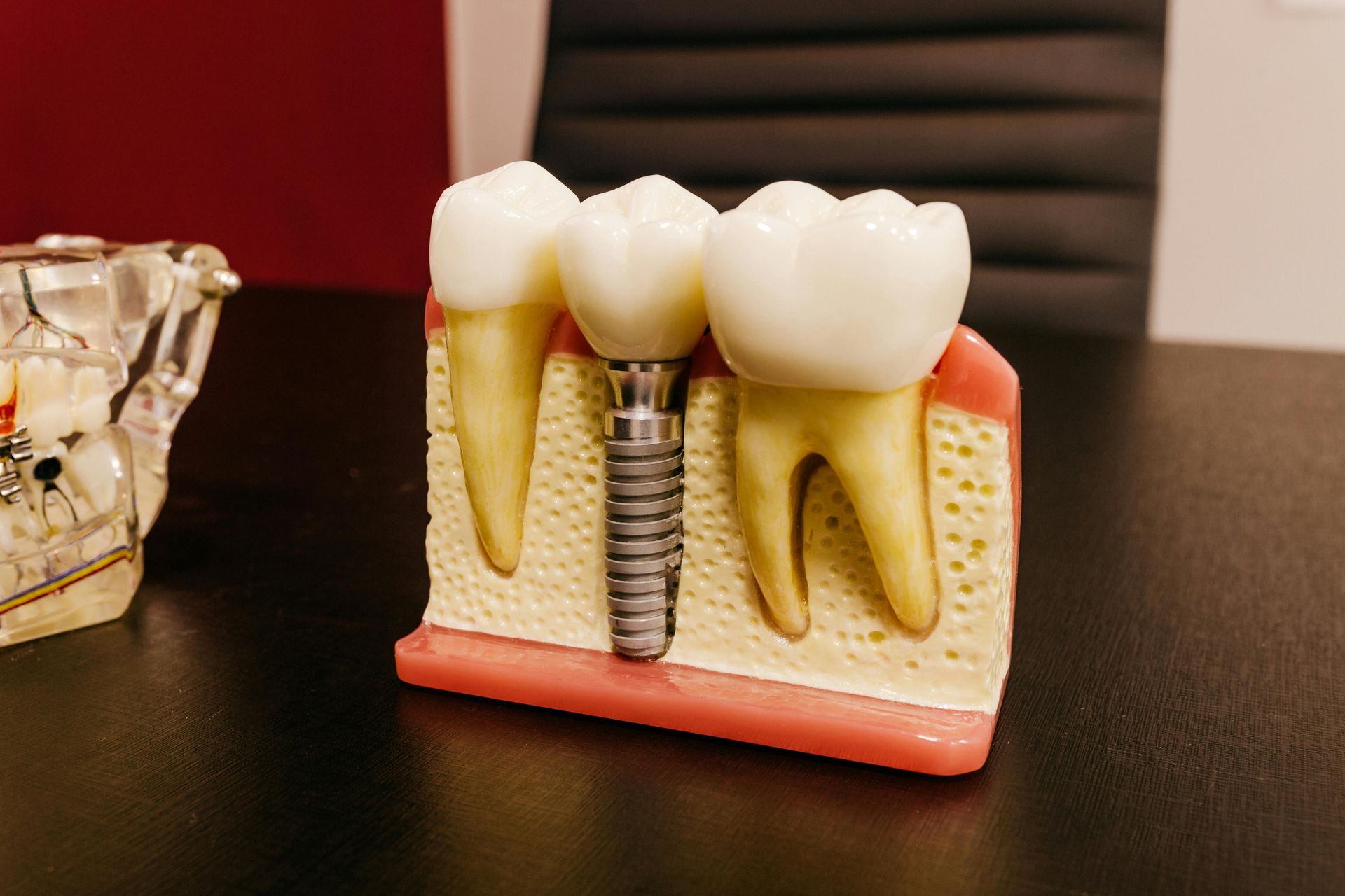 Dental implant model showing a tooth bridge and screw post on a tabletop