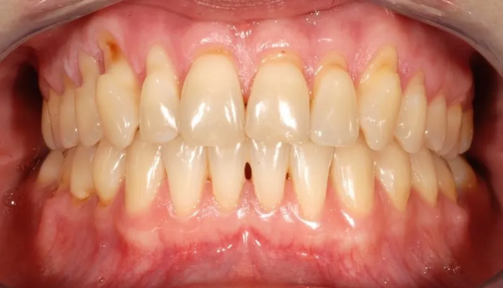 Receding gum treatment in Seattle