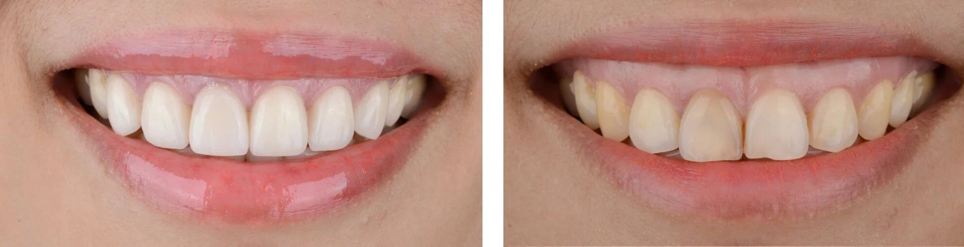 Two side-by-side close-ups of a smiling mouth, showing white teeth on the left and slightly yellowed teeth on the right