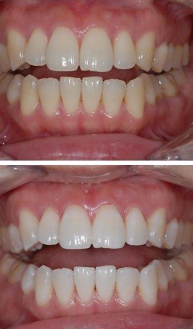 Seattle Teeth whitening pictures before and after