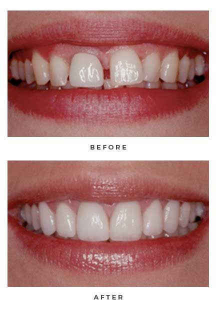 Veneers before and after for one of our North Seattle patients