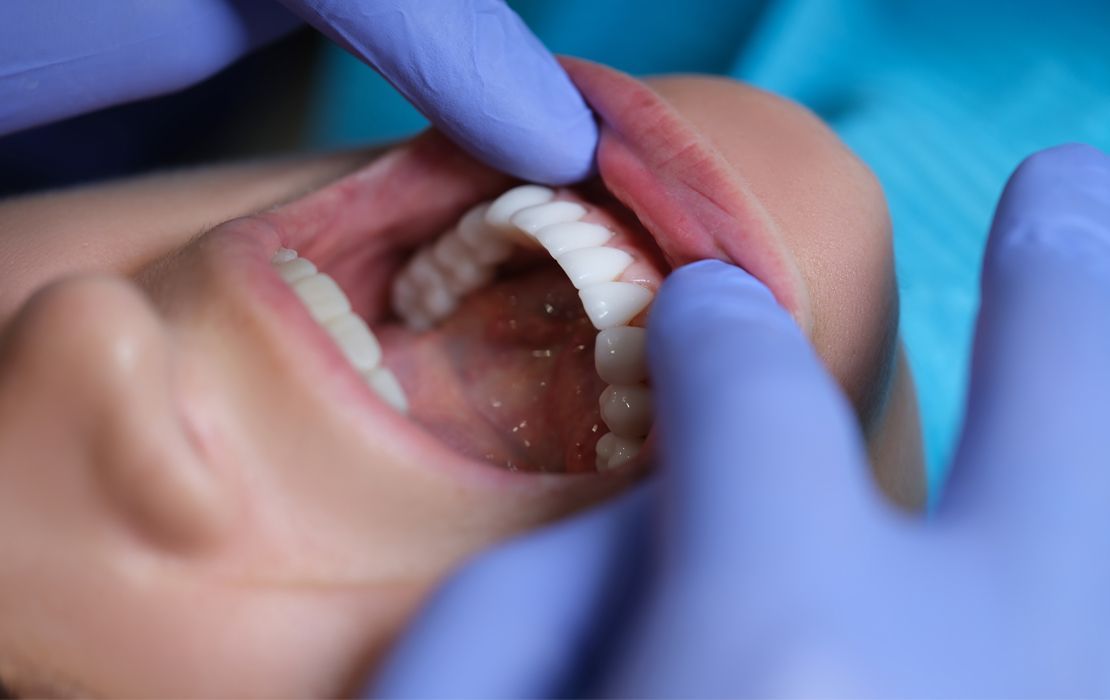 Zoom whitening at Aurora Dental Care in Seattle, Washington