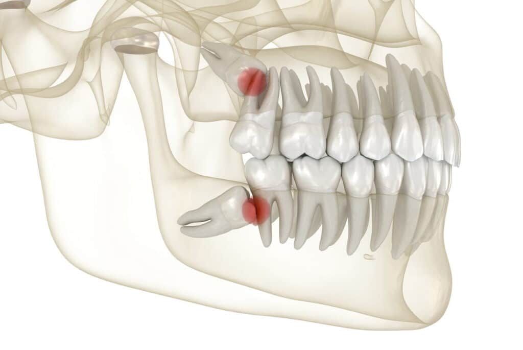 Wisdom Teeth Extractions in Seattle