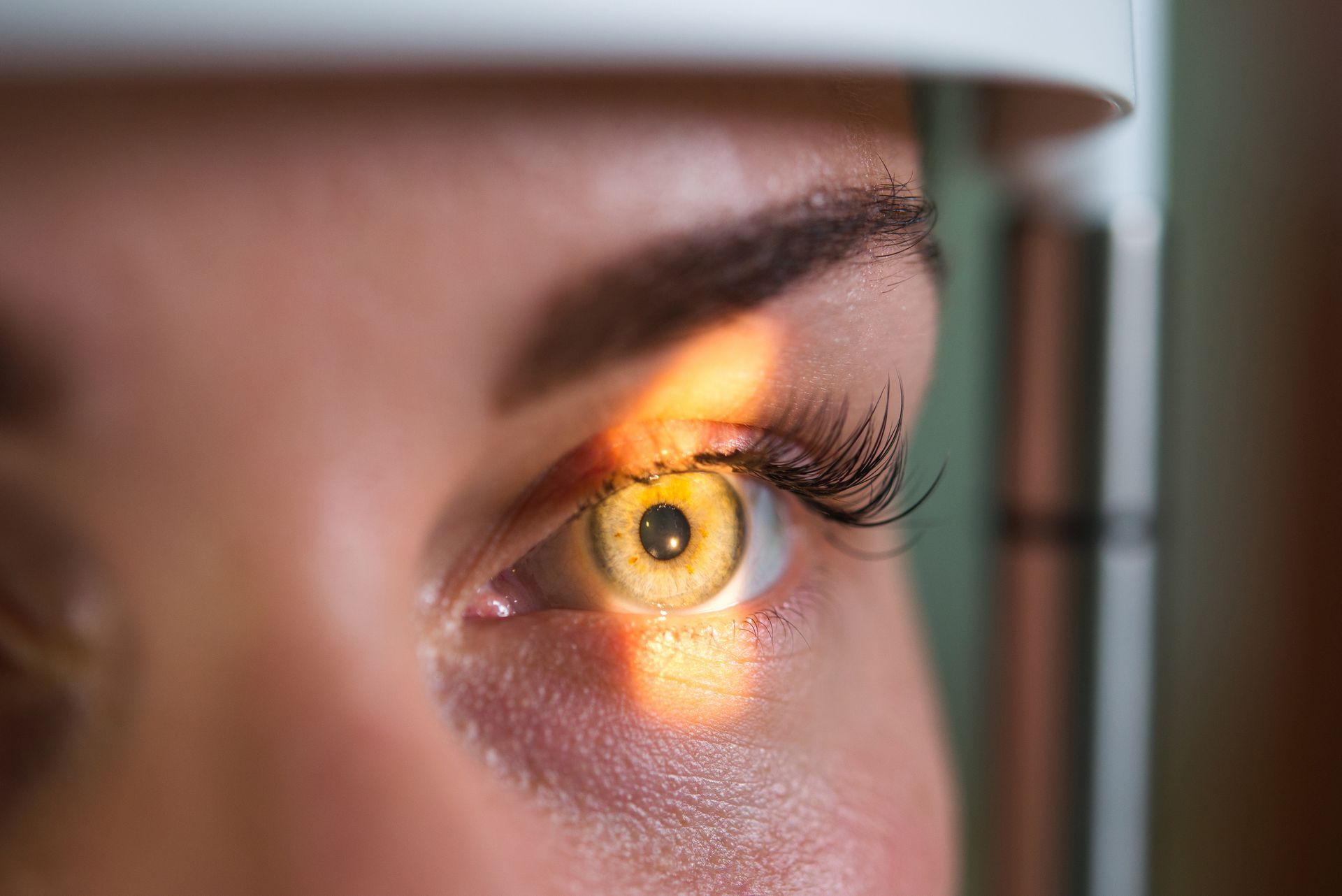 Close-up of a human eye being examined by a slit-lamp microscope with a bright yellow light directed at the iris. Close-up of a human eye being examined by a slit-lamp microscope with a bright yellow light directed at the iris.