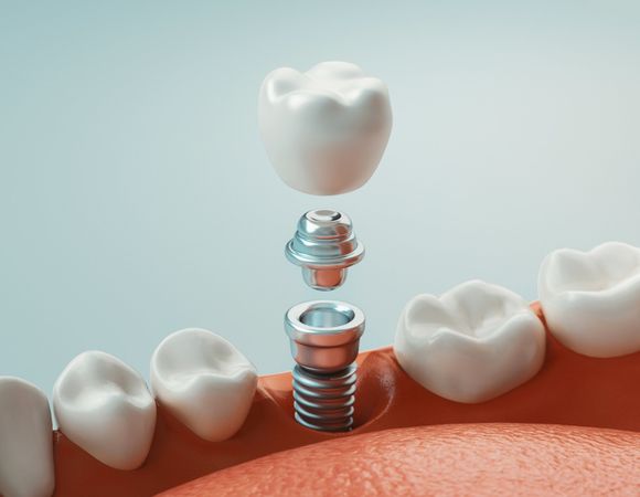 Impianti dentali