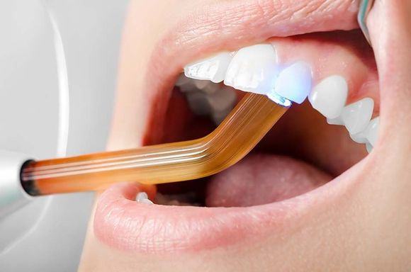 Faccette estetiche